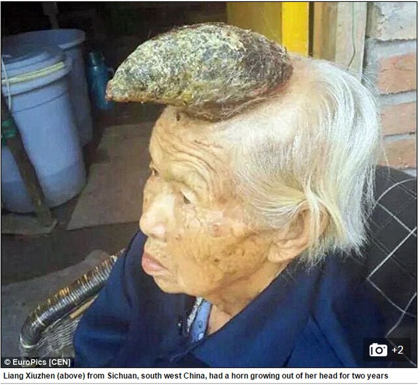 Una anciana china de 87 años tiene un cuerno de 13 centímetros creciendo en su frente