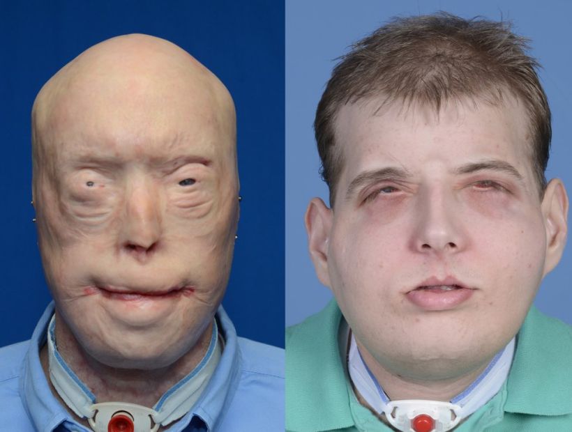 En EE.UU hicieron el trasplante de cara más complejo realizado hasta hoy
