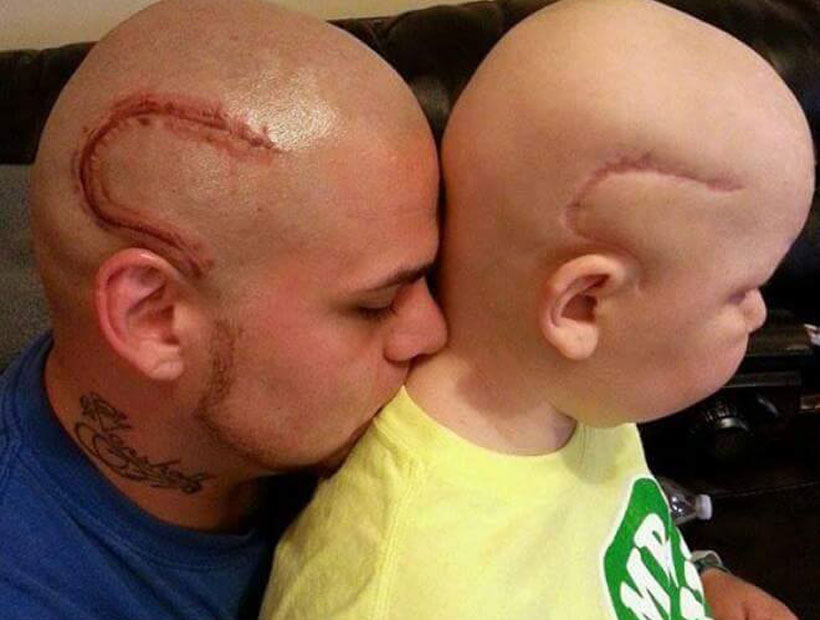 Padre se tatuó la cicatriz de su hijo afectado por un tumor cerebral