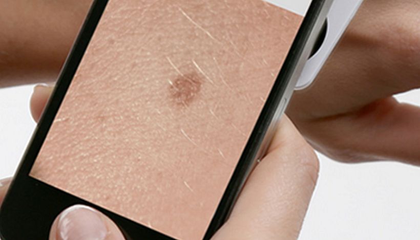 Aplicaciones móviles permitirán la detección temprana del cáncer de piel