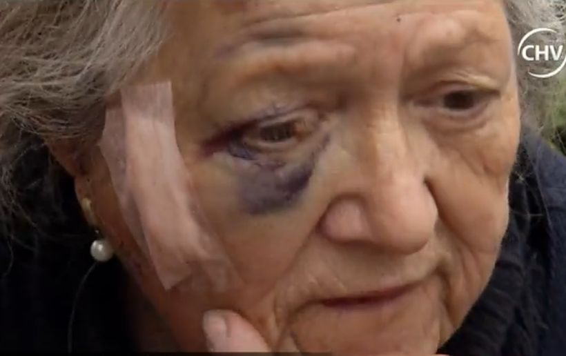 Anciana terminó con graves lesiones tras ser mordida por un perro callejero en El Bosque