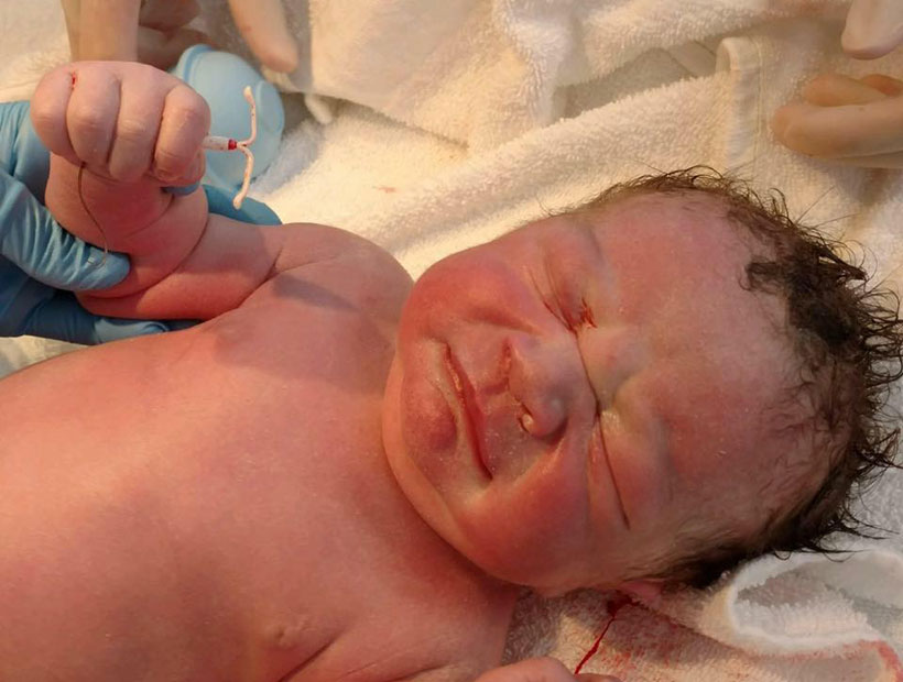 Una guagua nació sosteniendo el dispositivo intrauterino en su mano
