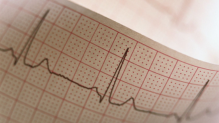 Mujeres jóvenes tienen mayor riesgo de morir en hospitales por infartos