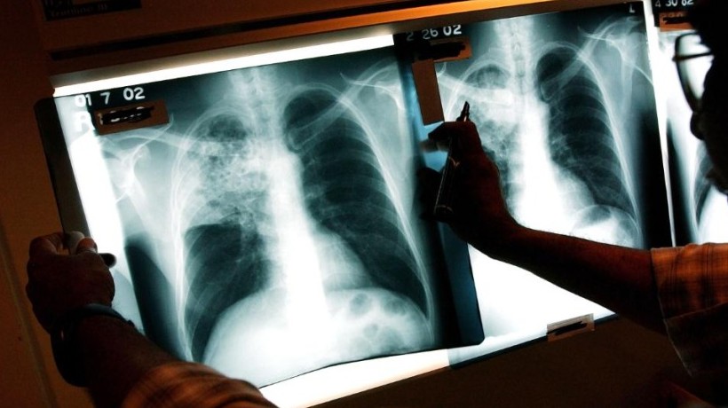 Antofagasta es la tercera región del país que tiene más incidencia de tuberculosis