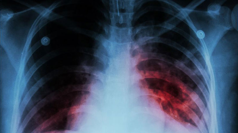 Tuberculosis: cómo se contagia, cuáles son sus síntomas y tratamiento