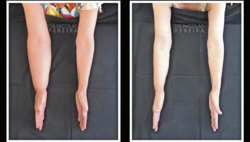 Linfedema, el mal que puede aparecer luego de tratar el cáncer de mama Linfedema, el mal que puede aparecer luego de tratar el cáncer de mama