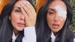 Pamela Díaz se tuvo que someter a intervención tras particular problema en su ojo: “No era orzuelo”