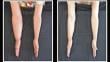 Linfedema, el mal que puede aparecer luego de tratar el cáncer de mama