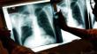 Tarapacá registra 46,8 casos de tuberculosis: la tasa más alta del país