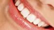 Llaman a evitar los blanqueamientos dentales sin supervisión
