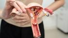 Día del Cáncer de Ovario: Siete de cada 10 casos se detectan tarde