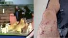 Joven quedó con múltiples mordeduras por ataque de perros en Barros Luco