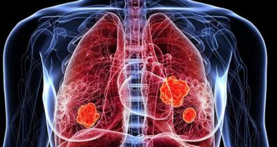 128 personas murieron de cáncer al pulmón durante el 2024 en la Región de Antofagasta