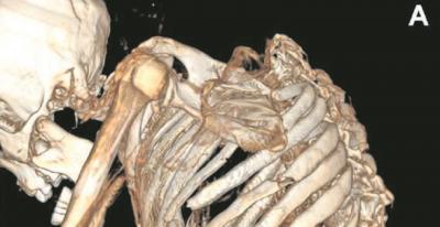 Derrumbe: Revelan causa de muerte de minero prehispánico del Desierto de Atacama