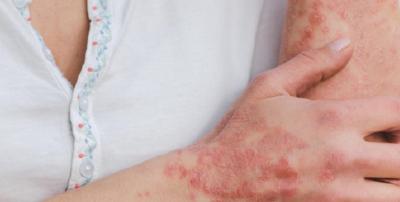 Sarna Noruega en Antofagasta: Cómo dectectar la infección y cuál son sus síntomas