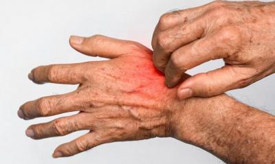 Especialista de UA advierte sobre el contagio de sarna Noruega por casos detectados en Antofagasta